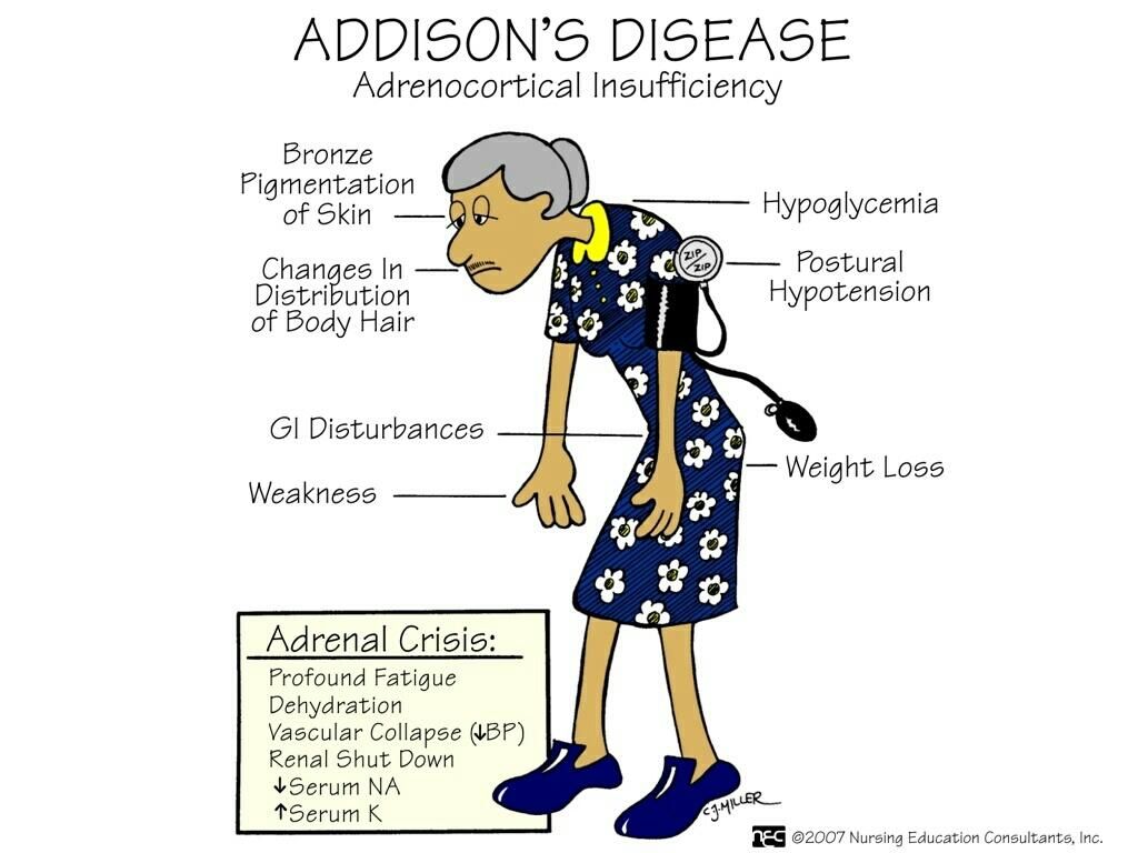 Addison’s disease