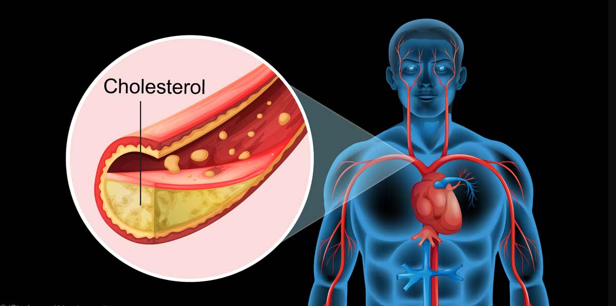 what is the symptom of high cholesterol